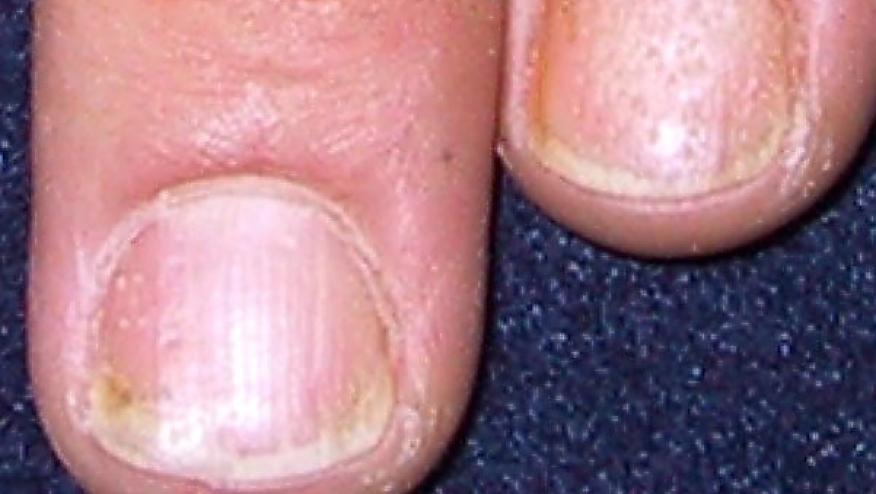 impact-of-nail-psoriasis-on-psoriatic-arthritis-rheumnow