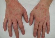 175px-Dermatitis2015.jpg