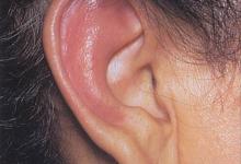 397_relapsing_polychondritis_slide_4_springer_high.jpg