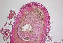 Giant-Cell_Vasculitis.jpg