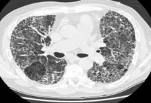IPF.CT_.jpg