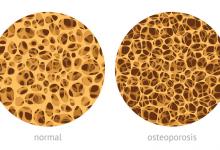 OP.Osteoporosis.bone_.jpg