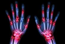arthritis.RA_.Xray_.hands_.jpg (keep)