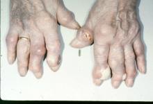 gout.tophi_.jpg