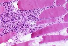 myositis.jpg