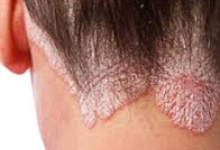 psoriasis.NPF_.png