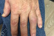psoriatic.PIP_.JPG