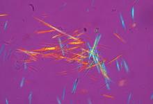 uric%20acid.crystals.gout_.JPG