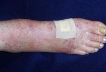 purpura
