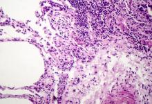 ILD damage fibrosis path