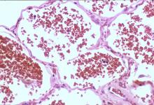 alveolar hemorrhage acute
