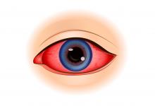 uveitis eye iritis