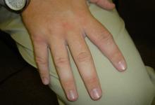 undifferentiated,arthritis,early,RA