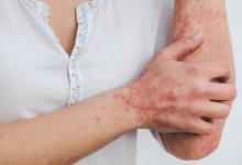 psoriasis,arm,hand,rash,elbow