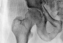 hip,fracture3