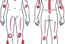 Pain,FM,fibromlyalgia,Trigger