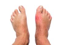 Gout,podagra,feet,292732063