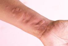 urticaria