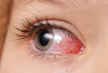 pediatric eye uveitis