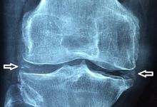 Chondrocalcinosis