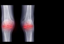 KNee.calcinosis.inflammatin