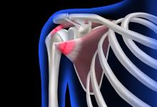 Rotator.Cuff.shoulder-pain