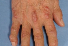 Multicentric reticulohistiocytosis