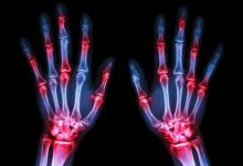 RA.Xray.Hands
