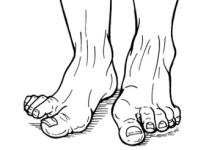 MTP.Hallux