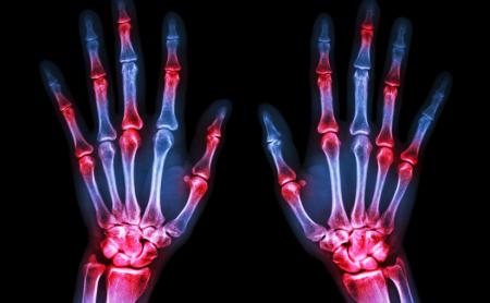 arthritis