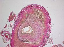 Giant-Cell_Vasculitis.jpg