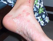 PSORIASIS.LH_.jpg