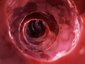 colitis.jpg
