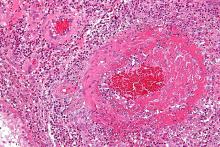 vasculitis.Churg-Strauss_syndrome.wikipedia.jpg