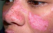 DLE discoid lupus