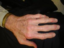 RA Hands Difficult deformity