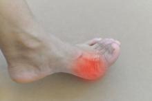 gout podagra inflammed