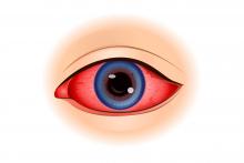 uveitis eye iritis