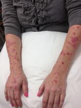 Psoriasis, arms, PsA