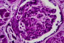 DPGN, lupus, nephritis, GN, glomerulonephritis, biopsy, kidney