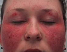 Malar,rash,SLE, Lupus
