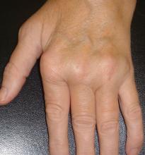 RA, hands, MCP, deformity