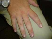 undifferentiated,arthritis,early,RA