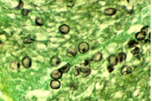 pneumocystis,PJP