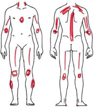 Pain,FM,fibromlyalgia,Trigger