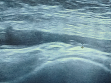 US the axillary artery of a patient with polymyalgia rheumatica without cranial symptoms. Three years after diagnosis at the third relapse after tapering glucocorticoids.