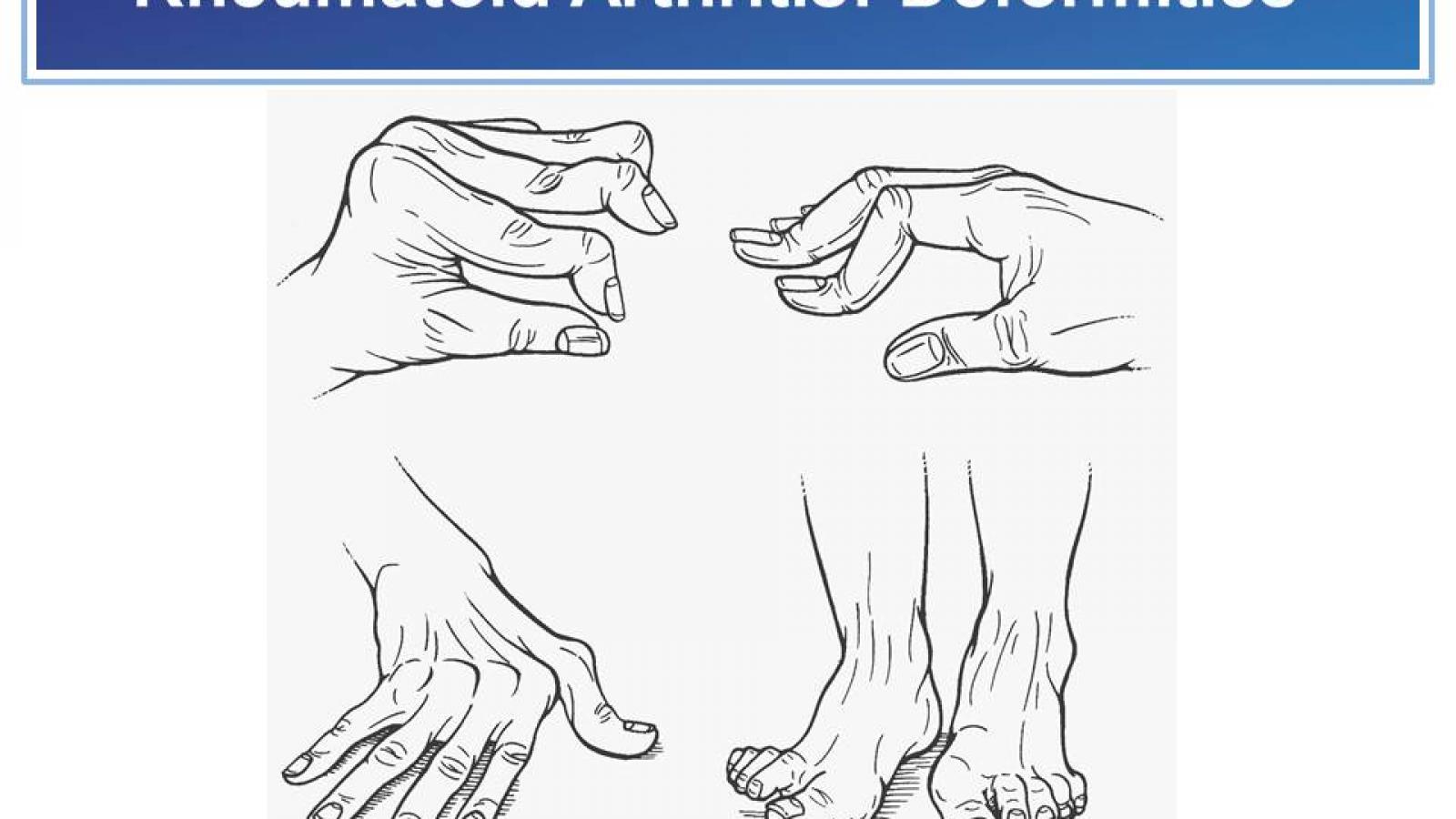 RA%20deformities.jpg