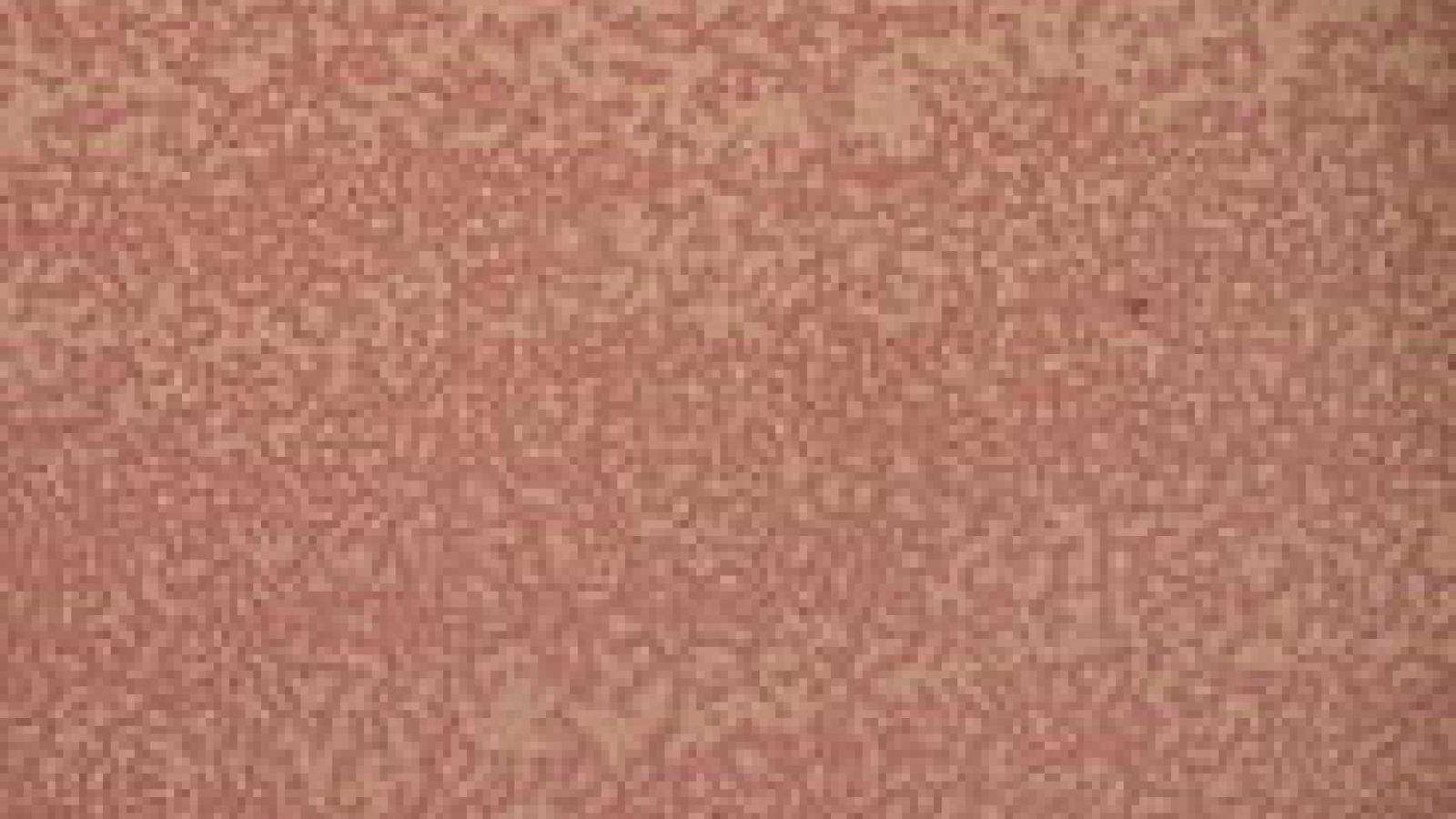 184px-Neutropenia.JPG