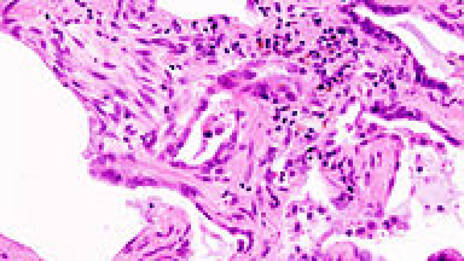 192px-Usual_interstitial_pneumonia_%281%29.JPG