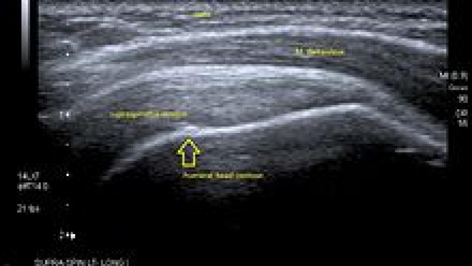 220px-Longitudinal_US_supraspinatus.jpg